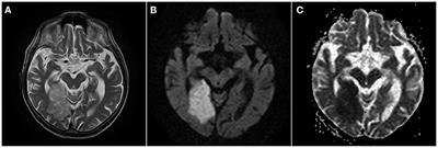Radiological Manifestation of Neurological Complications in the Course of SARS-CoV-2 Infection